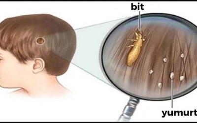Bu Sırrı Doktorlar Bile Açıklamıyor – İşte Çocuğunuza Geçen Bitten Kurtulmanın Kesin Yöntemi